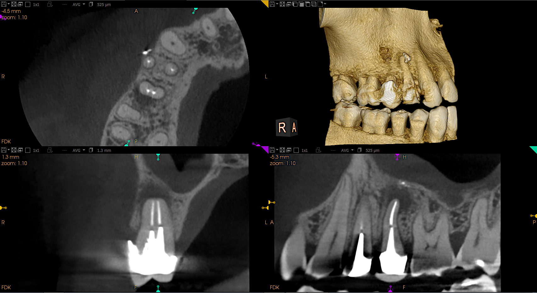 zdjęcie tomograficzne szczęki